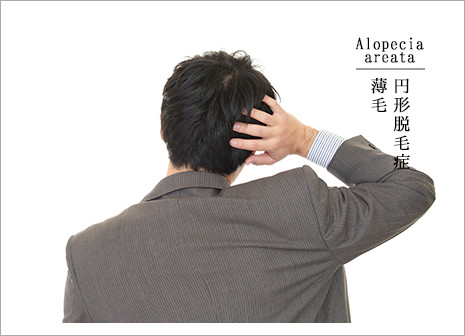 Alopecia areata 円形脱毛症薄毛